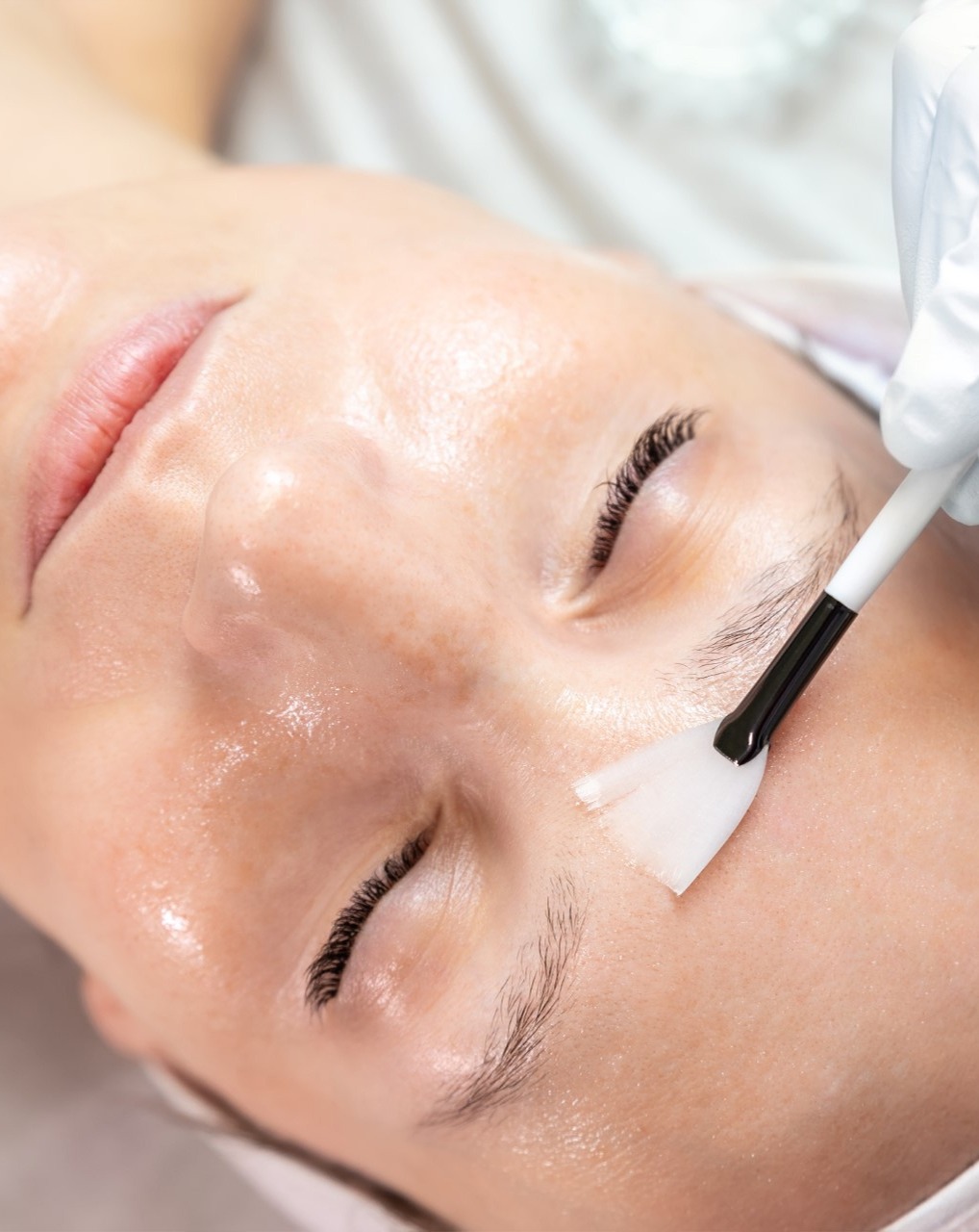 Chemical peels in Trenton Michigan - LTD Aesthetics Wellness (1)